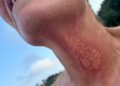 Jellyfish Sting Creates New Drug
