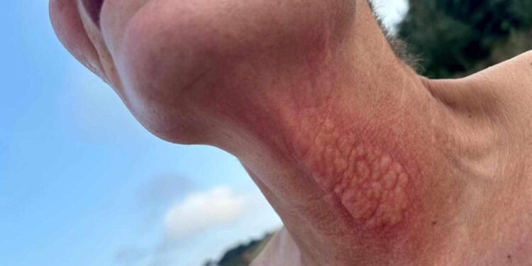 Jellyfish Sting Creates New Drug