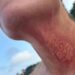 Jellyfish Sting Creates New Drug
